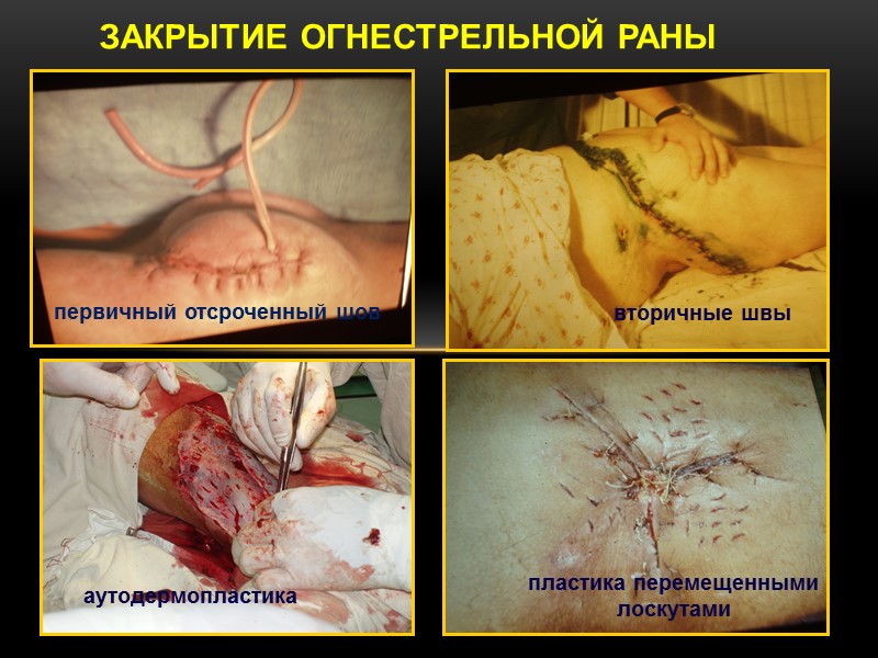 ЗАКРЫТИЕ ОГНЕСТРЕЛЬНОЙ РАНЫ аутодермопластика пластика перемещенными лоскутами вторичные швы первичный отсроченный шов